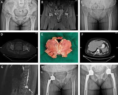 Phosphaturic mesenchymal tumor-induced bilateral osteomalacia femoral neck fractures: a case report
